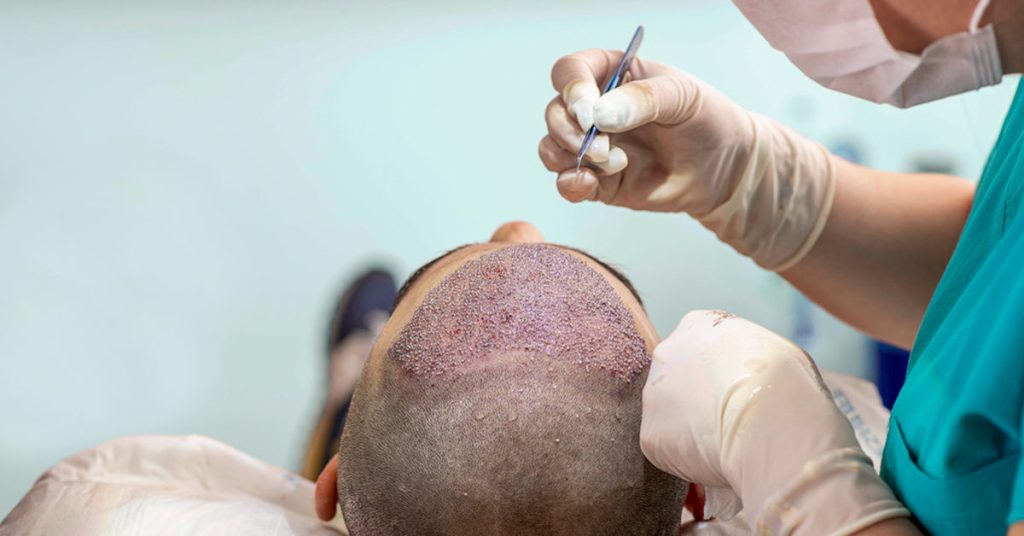 What Is the FUE Hair Transplant?