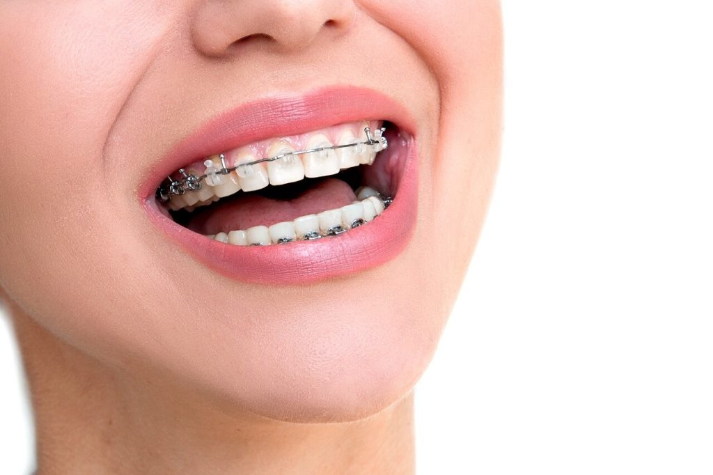 Transforming Smiles: The Basics Of Orthodontic Treatment